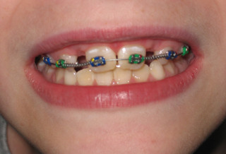 David's Braces